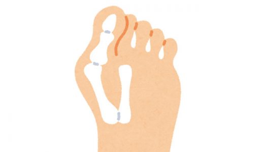 外反母趾の治し方-自分でできるストレッチ